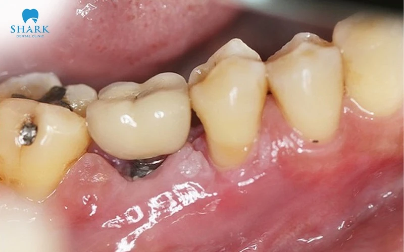 Cấy trụ Otex khó tránh khỏi vấn đề nhiễm trùng vì vật liệu không đảm bảo