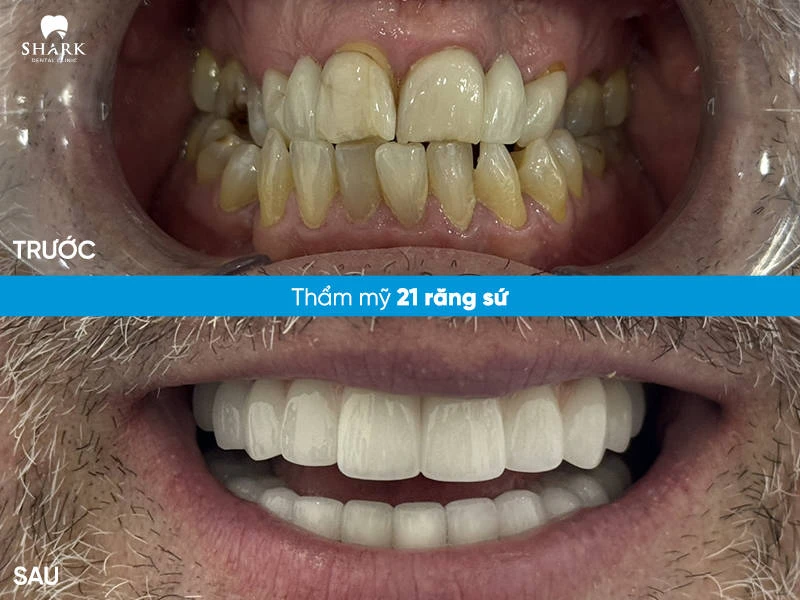 Hình ảnh toàn hàm trước và sau khi điều trị