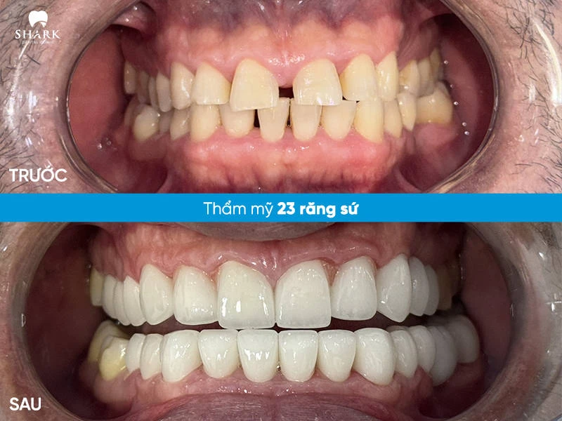 Anh Hải – Thẩm mỹ 23 răng sứ để khắc phục răng thưa