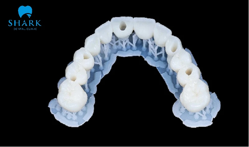 Mô phỏng hình ảnh 5 trụ răng sau khi cấy