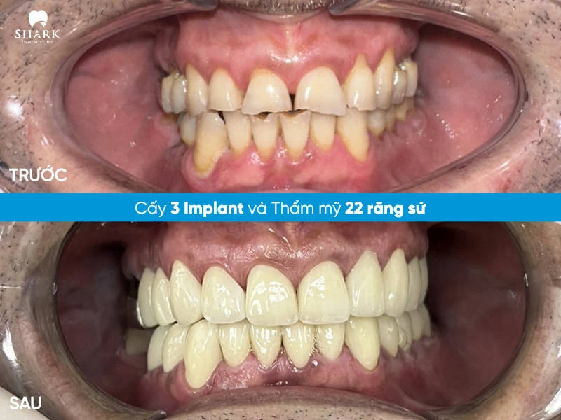 Chú Cường – Cấy ghép 3 trụ Implant và bọc 22 răng sứ
