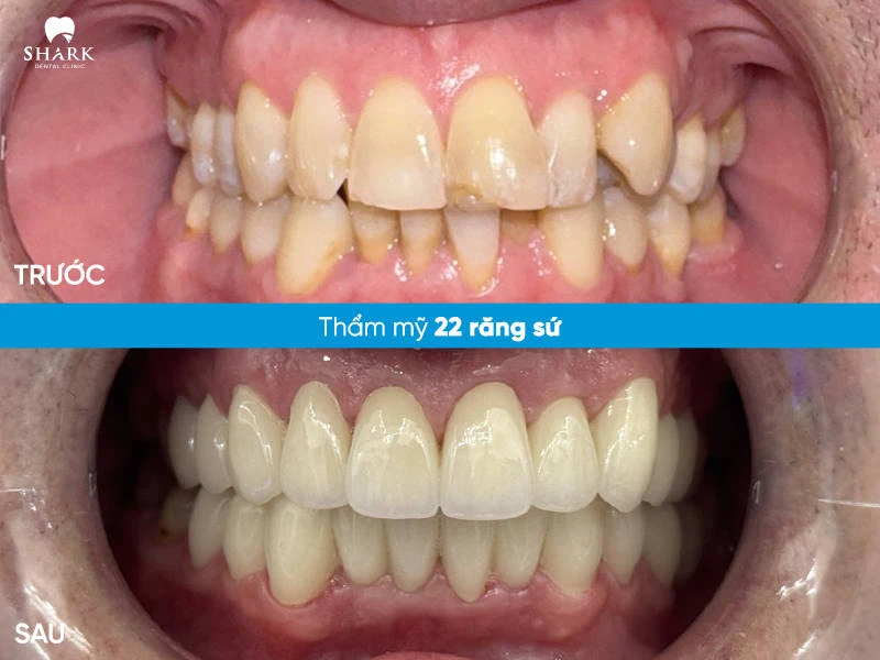 Hình ảnh toàn hàm trước và sau khi điều trị của anh Quốc Bảo