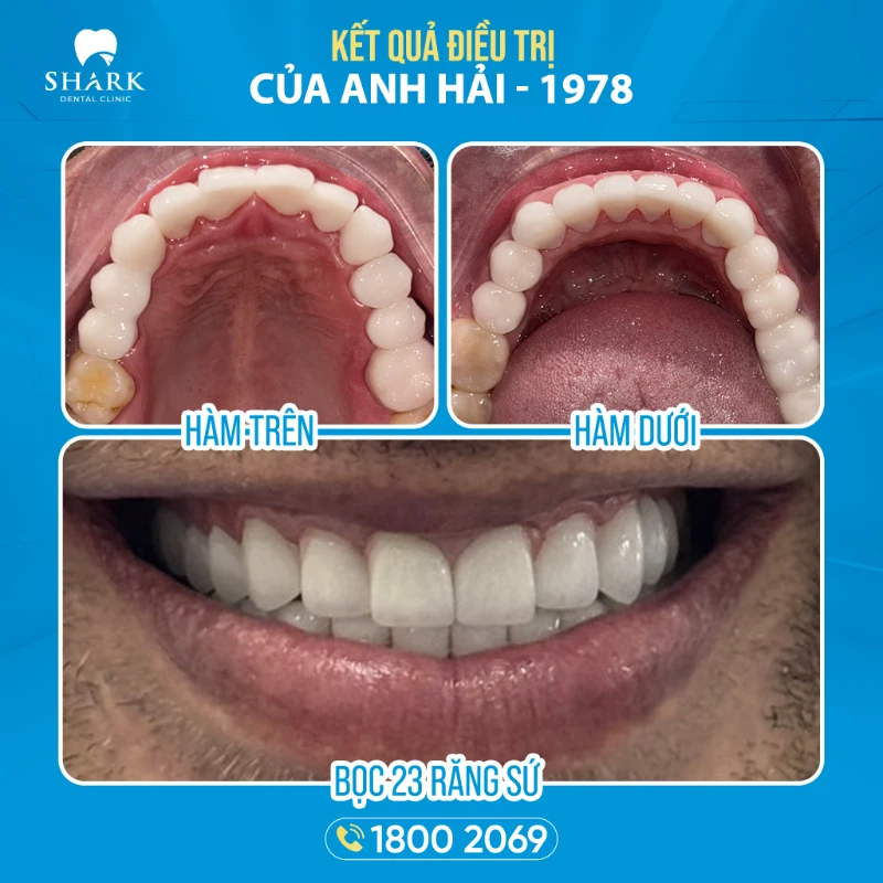 Kết quả sau khi điều trị răng cho anh Hải