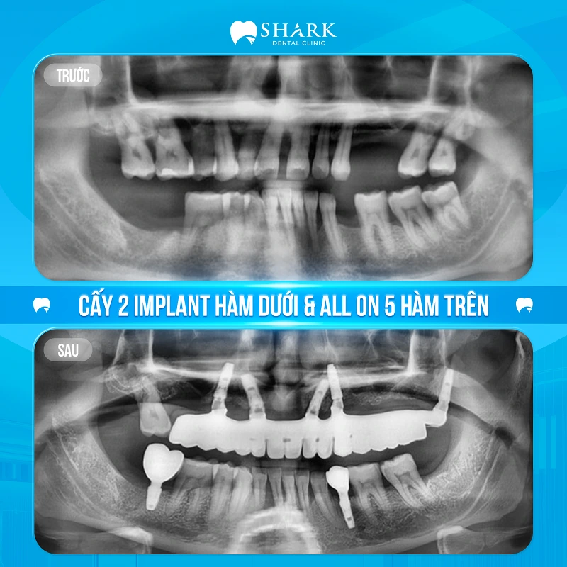 Anh Tuấn - Cấy 2 Implant hàm dưới và All on 5 hàm trên 2 Hình ảnh X-quang sau khi cấy Implant