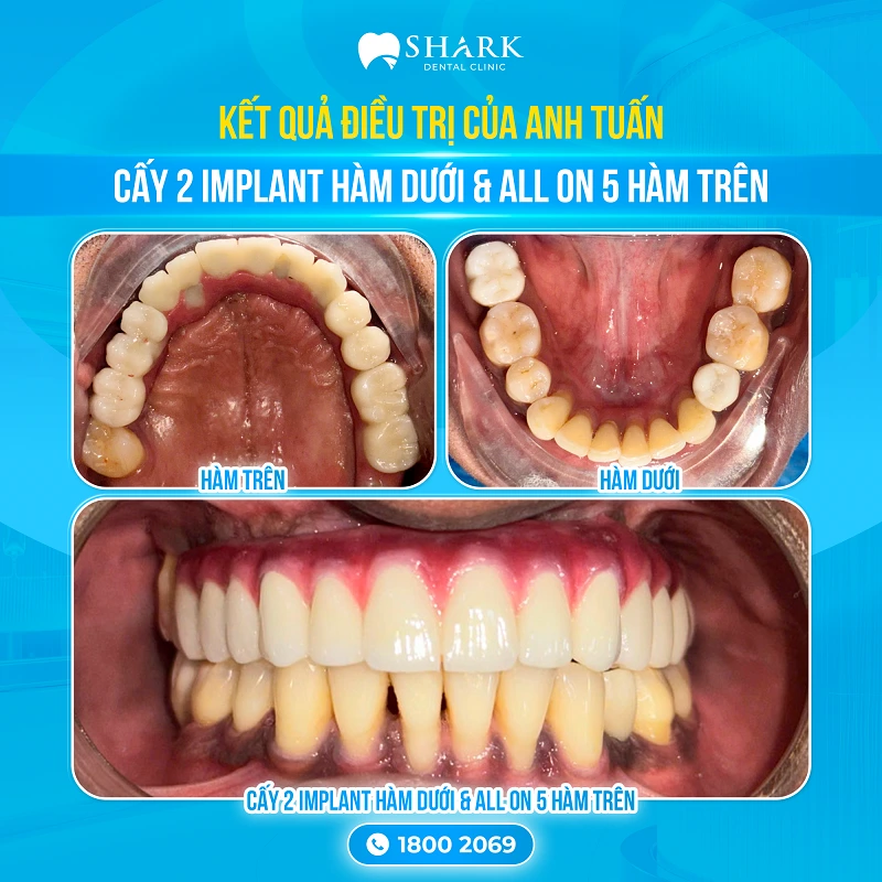 Anh Tuấn - Cấy 2 Implant hàm dưới và All on 5 hàm trên 3 Kết quả sau khi điều trị cấy ghép răng của anh Tuấn