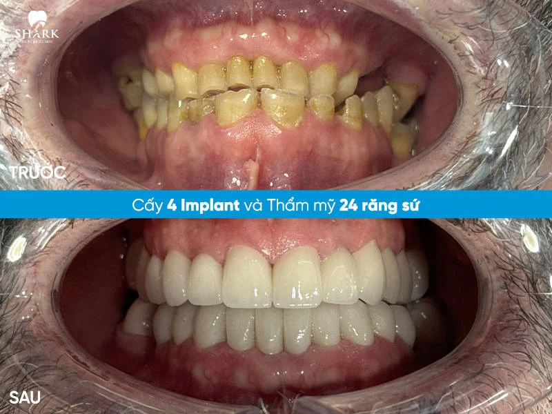 Chú Tuấn Anh – Cấy ghép 4 trụ Implant và bọc sứ 24 răng