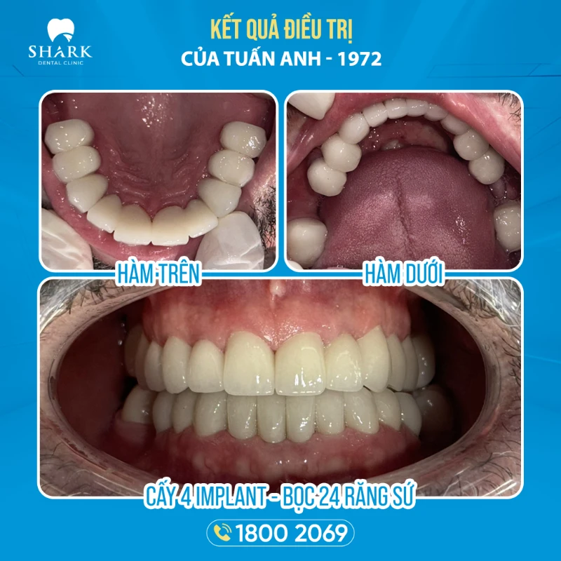 Kết quả sau khi cấy 4 trụ Implant và bọc 24 răng sứ cho chú Tuấn Anh