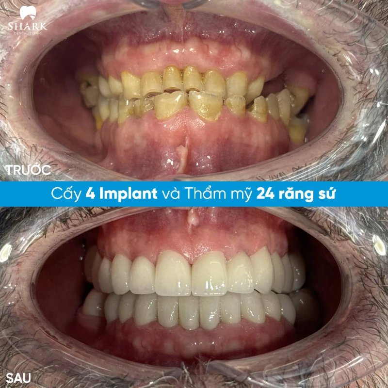 Hình ảnh trước sau khi làm răng sứ cho chú Tuấn Anh