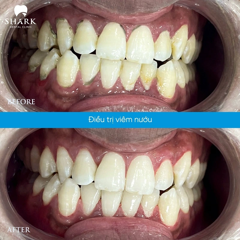 Anh Ngọc Hiệp lấy cao răng