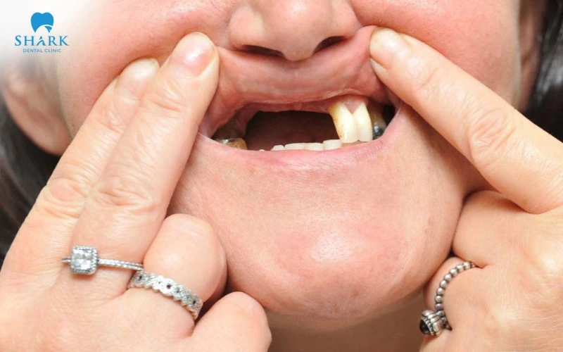 Mất răng toàn hàm và xương hàm có tốt thì có thể cấy implant all on 5 dễ dàng