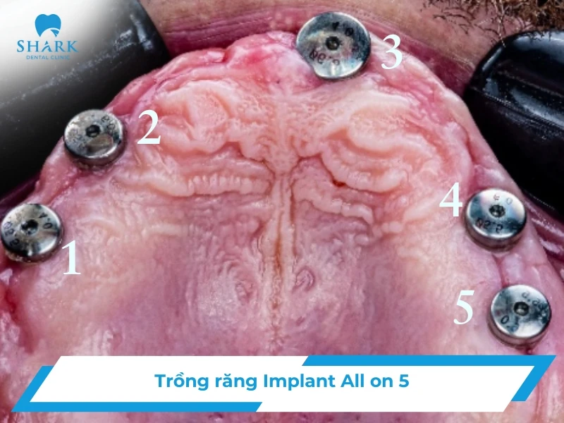 Cấy ghép Implant All on 5