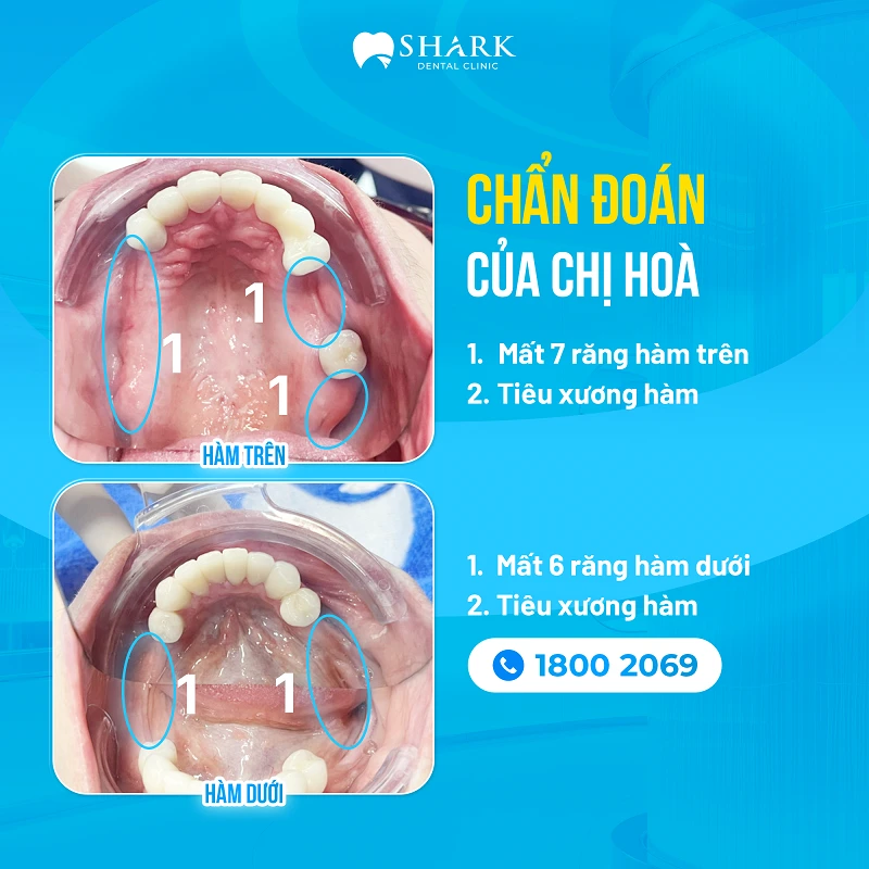 Chị Hòa - Cấy 5 Implant hàm trên & 4 Implant hàm dưới 1 Chẩn đoán tình rạng của chị Hòa