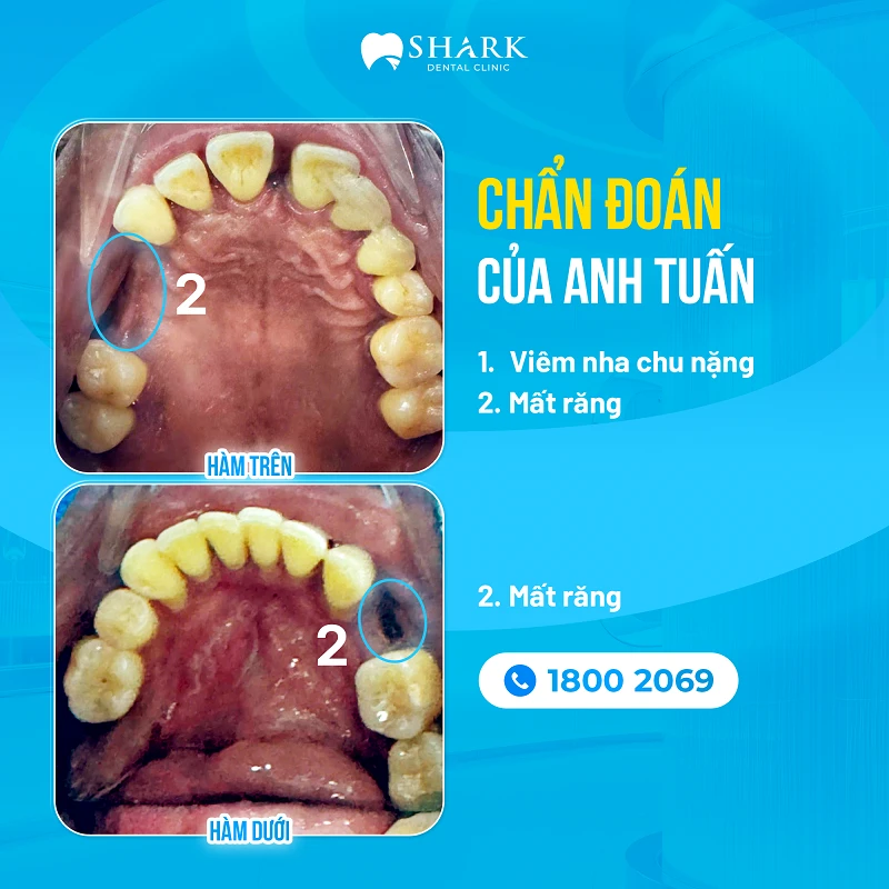 Anh Tuấn - Cấy 2 Implant hàm dưới và All on 5 hàm trên 1 Hình ảnh chẩn đoán của anh Tuấn trước khi điều trị
