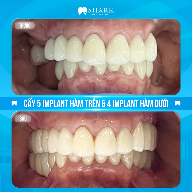 Chị Hòa – Cấy 5 Implant hàm trên & 4 Implant hàm dưới