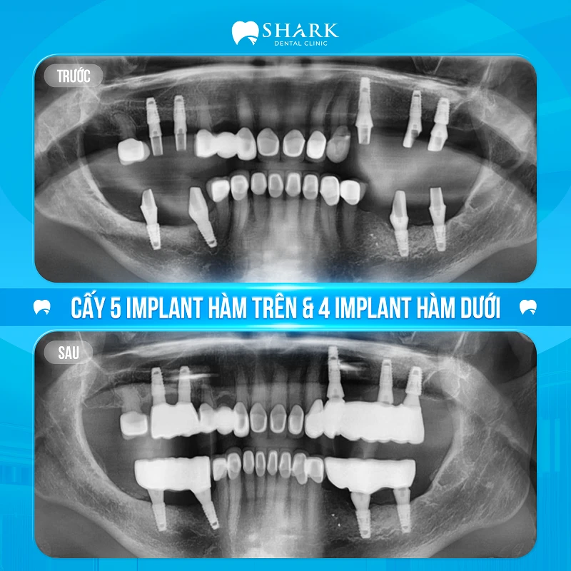 Chị Hòa - Cấy 5 Implant hàm trên & 4 Implant hàm dưới 2 Phim X-quang của chị Hòa sau khi cấy ghép trụ