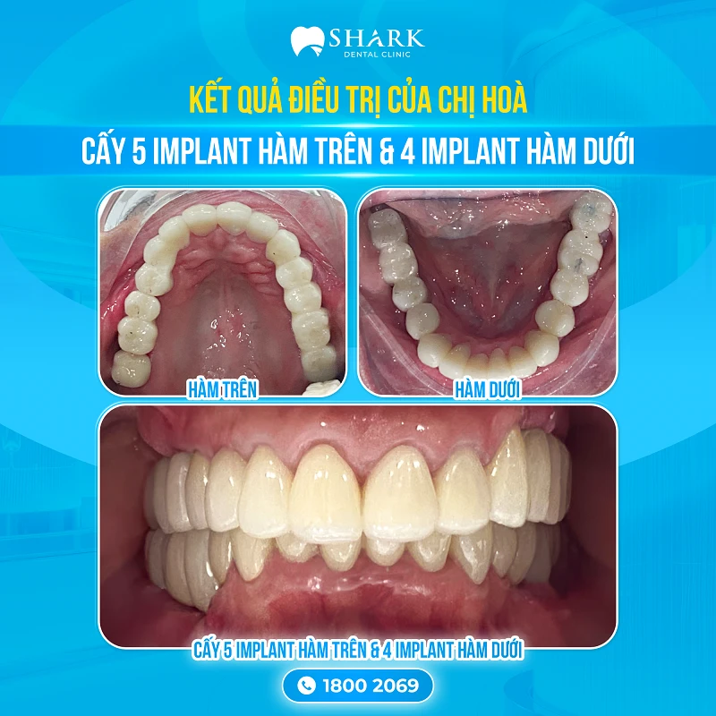 Chị Hòa - Cấy 5 Implant hàm trên & 4 Implant hàm dưới 3 Kết quả cấy ghép Implant của chị Hòa