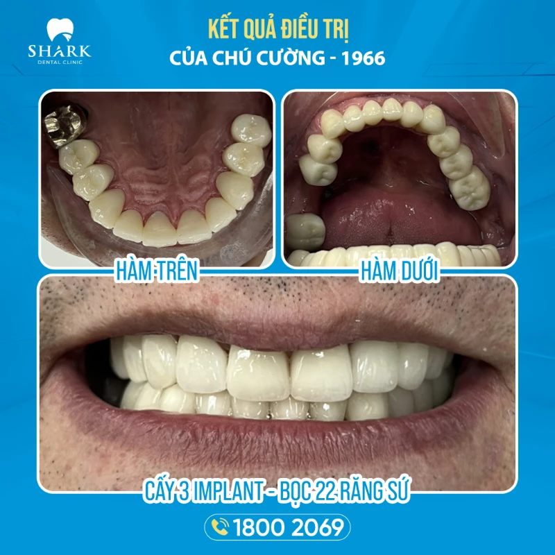 Kết quả sau khi chú Cường trồng 3 trụ Implant và bọc 22 răng sứ