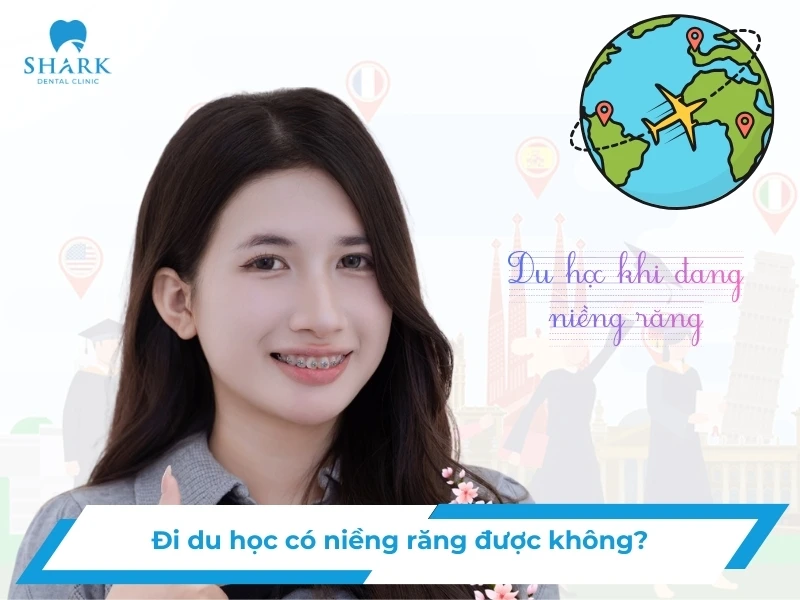 Đi du học có niềng răng được không