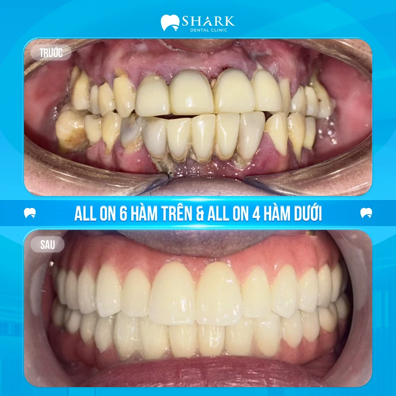 Anh Hải Đăng – Cấy ghép Implant All on 6 hàm trên & All on 4 hàm dưới