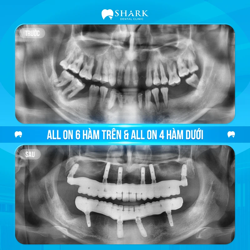 Phim chụp tình trạng sau khi cấy ghép răng cho anh Hải Đăng