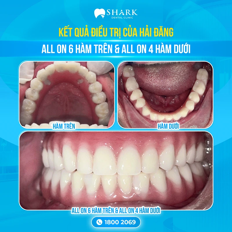 Kết quả sau khi trồng răng