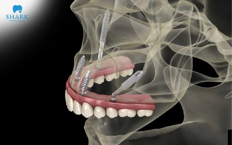 Implant chân bướm