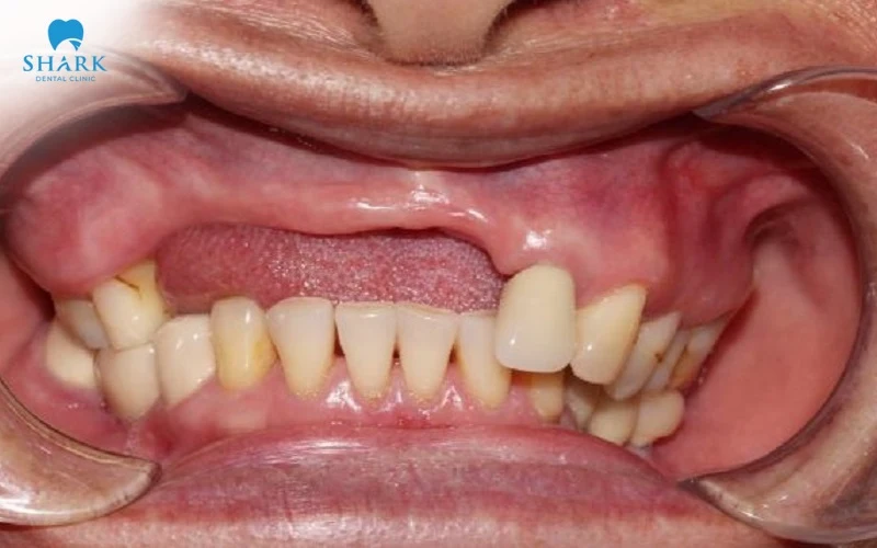 Hình ảnh bị tiêu xương hàm trên là đối tượng phù hợp nhất để cấy ghép răng xương chân bướm