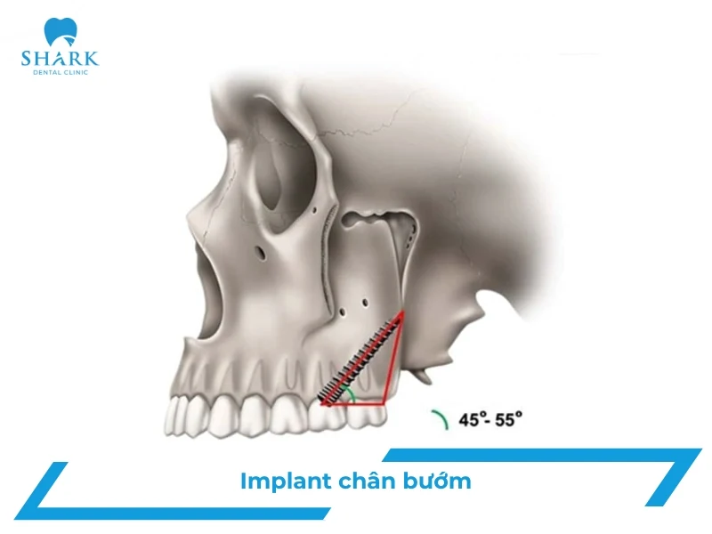 Cấy ghép Implant chân bướm: Không nâng xoang, ghép xương 51 Implant chân bướm