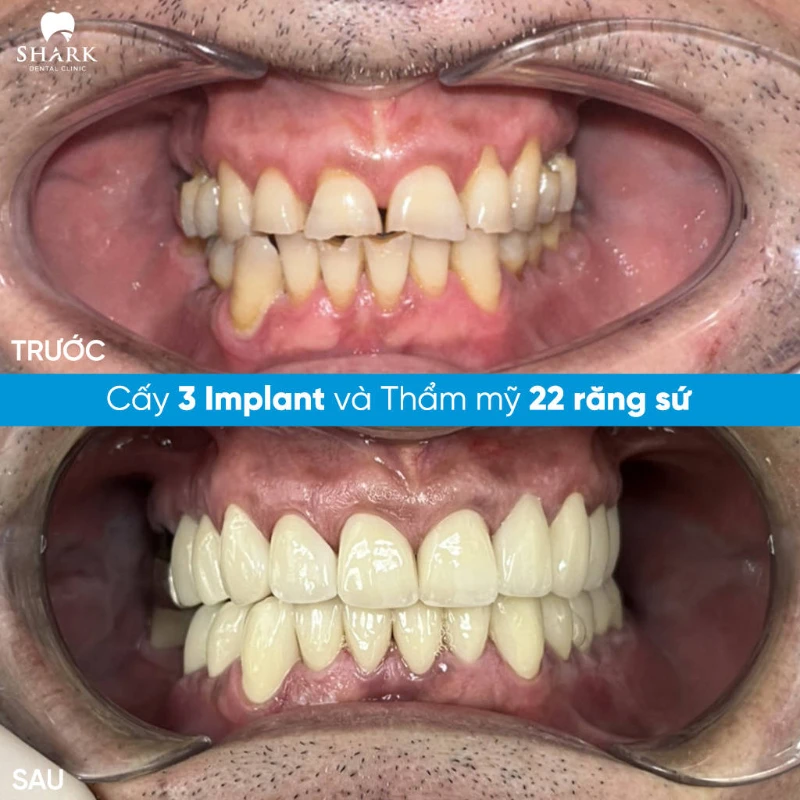 Hình ảnh trước sau của chú Cường sau khi làm răng sứ