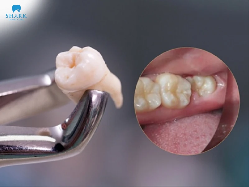 Răng khôn mọc lệch khi nhổ có giá từ 3.000.000 - 5.000.000 VNĐ/Răng