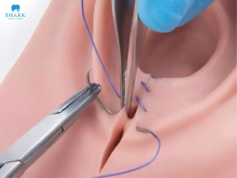 Nhổ răng khôn chỉ tự tiêu cần bao nhiêu thời gian tiêu huỷ? 17 Chỉ nha khoa tự tiêu trong bao lâu? Khoảng 10 ngày để tự tiêu hủy