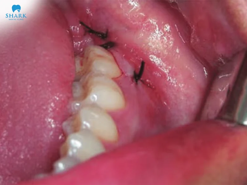 Nhổ răng khôn chỉ tự tiêu cần bao nhiêu thời gian tiêu huỷ? 18 Cần xử lý chỉ khi nhổ răng khôn để không gây ảnh hưởng đến sức khỏe