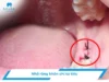 Nhổ răng khôn chỉ tự tiêu cần bao nhiêu thời gian tiêu huỷ?