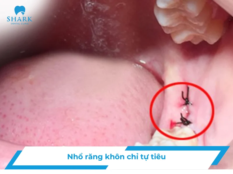 nho-rang-khon-chi-tu-tieu-avt