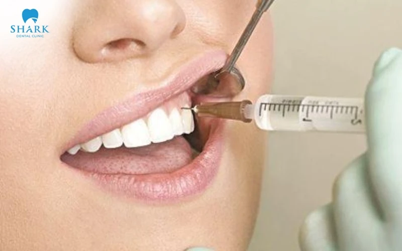 Niềng răng có tiêm thuốc tê không? Bác sĩ nha khoa giải đáp 5 Thuốc tê khi chỉnh nha không được dùng trong giai đoạn gắn mắc cài và siết dây cung