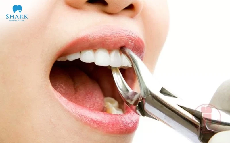 Niềng răng có tiêm thuốc tê không? Bác sĩ nha khoa giải đáp 6 Giai đoạn nhổ răng trước khi niềng có thể được chỉ định tiêm tê