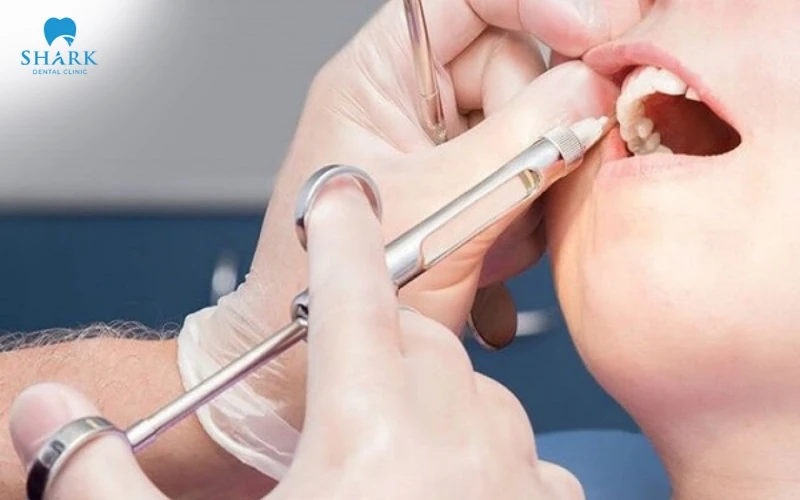 Niềng răng có tiêm thuốc tê không? Bác sĩ nha khoa giải đáp 7 Tiêm thuốc tê khi niềng răng