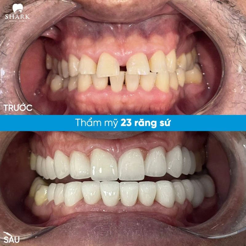 Răng trước sau khi điều trị