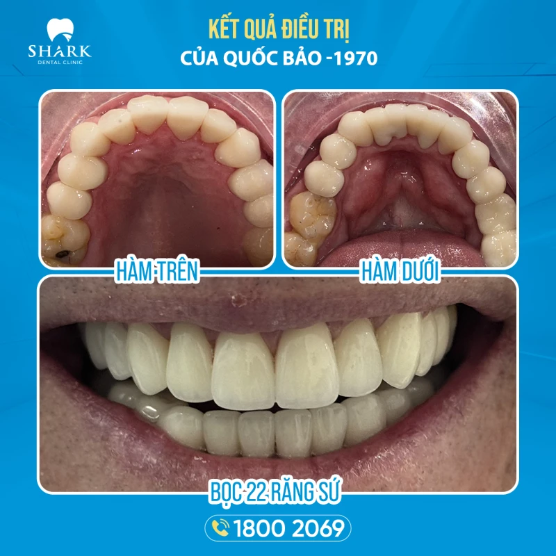 Kết quả sau khi điều trị