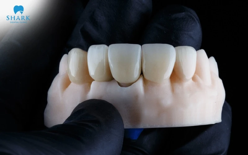 Răng sứ Cercon HT có tốt không? Giá bọc răng sứ Cercon HT 13 Giá bọc sứ Cercon HT dao động từ 5-8 triệu tùy nha khoa