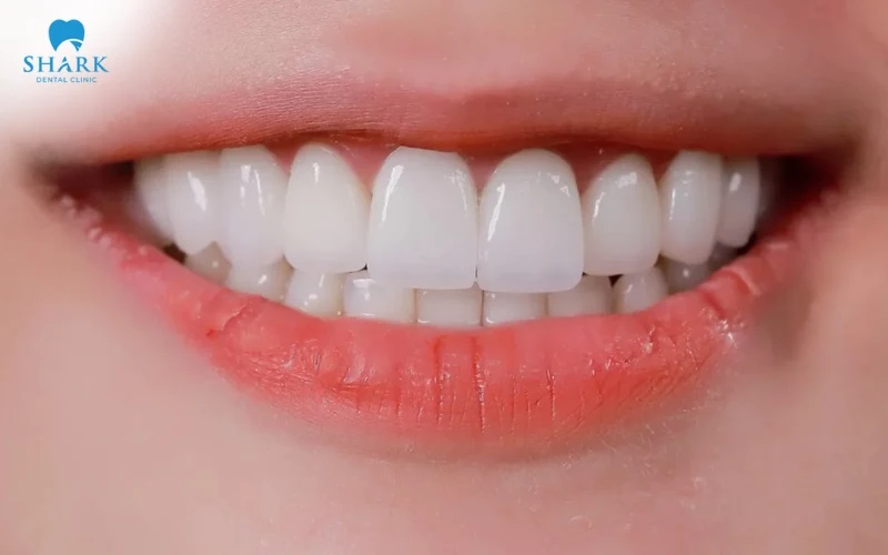 Răng sứ Jelenko có mức giá ổn định tại thị trường Việt Nam