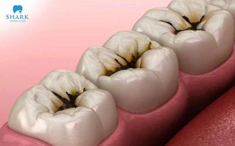 Sâu răng là trường hợp phổ biến nhất dẫn đến việc trám răng