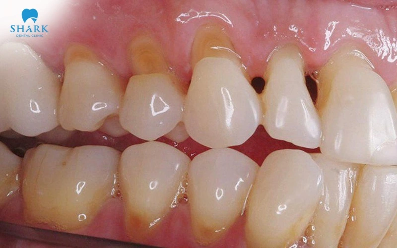 Trám răng giúp lấy đầy phần bị mòn, giảm ê buốt và bảo vệ răng tốt hơn