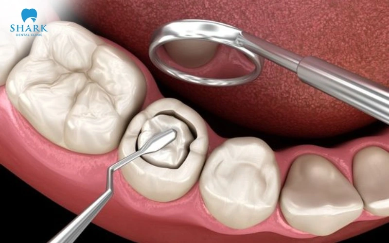 Trám răng là một kỹ thuật nha khoa tương đối đơn giản và hầu như không gây đau nhức hay khó chịu