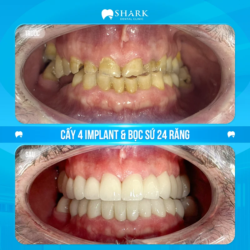 Anh Tuấn Anh – Cấy 4 Implant và bọc sứ 24 răng