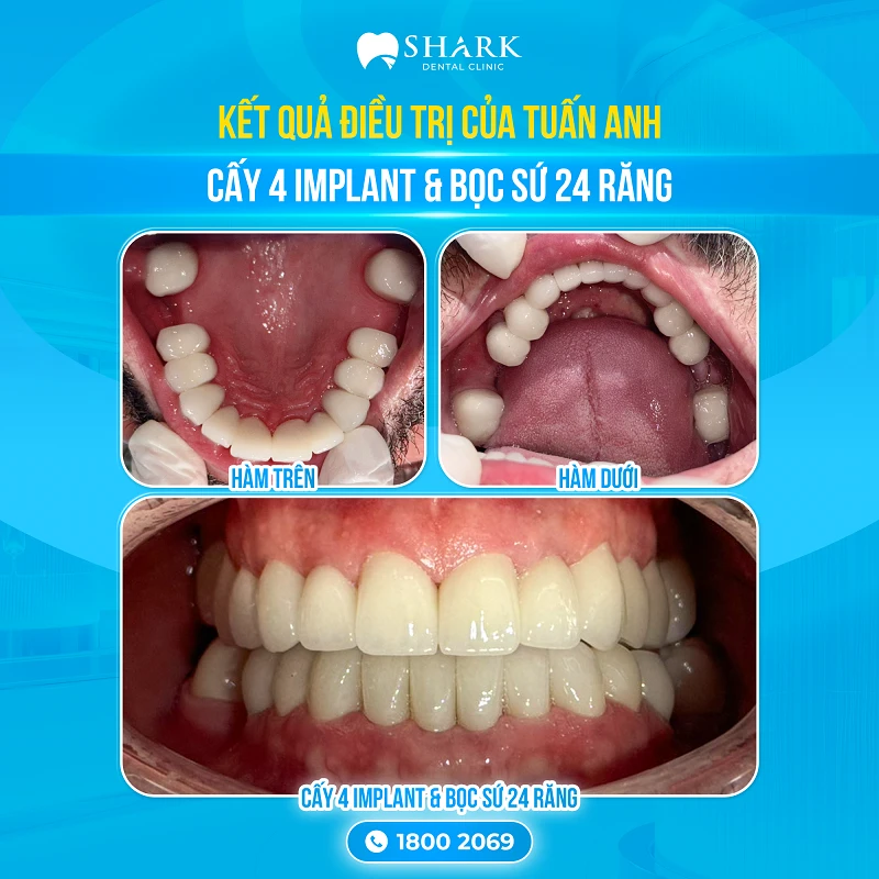 Kết quả sau khi điều trị