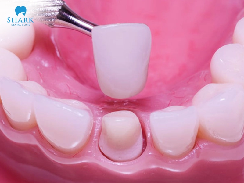 Bọc răng sứ giúp duy trì độ bền và màu sắc lâu dài