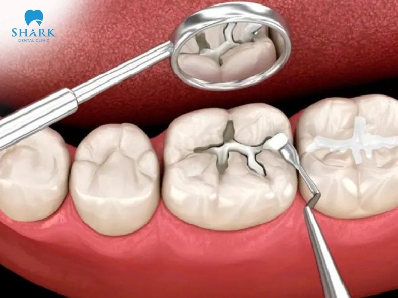 Thay miếng trám răng mới giúp răng chắc khỏe và sáng đẹp hơn