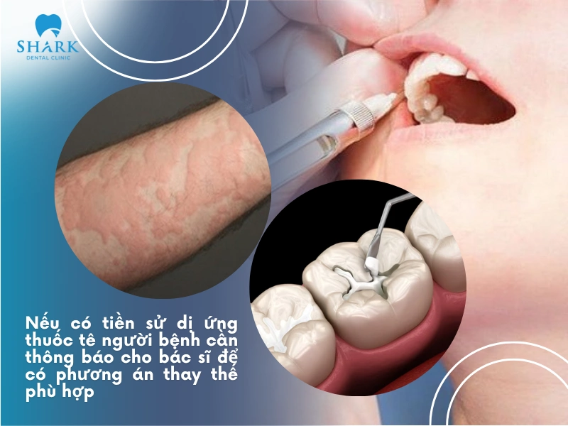 Cần thông báo trước với bác sĩ khi bạn có tiền sử dị ứng thuốc tê để cân nhắc sử dụng phương án phù hợp