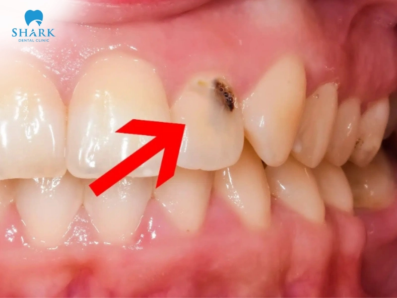 Trám răng sâu là giải pháp nhanh và an toàn